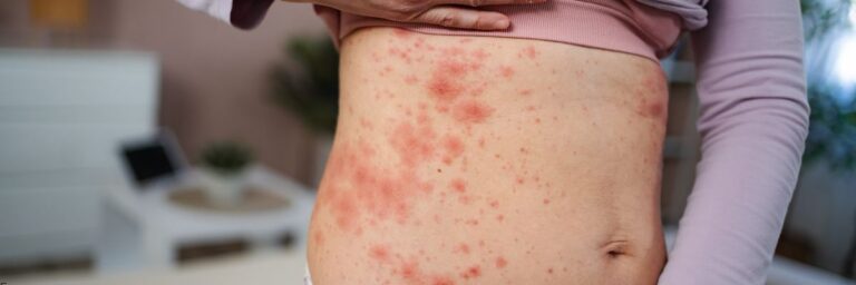 Pişik Önleme ve Bakım